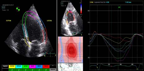 Speckle Tracking Echocardiography