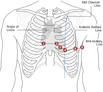 Diagram showing the placement of the 6 chest leads