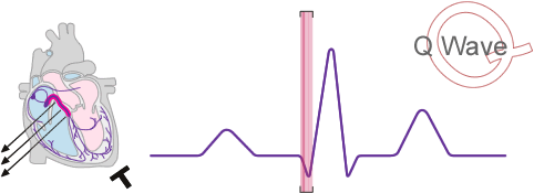 Diagram of the Q wave section of the sinus wave