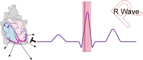 Diagram of the R wave section of the sinus wave