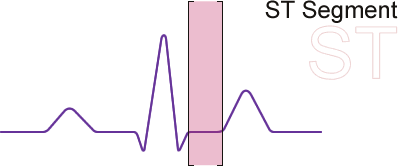 Diagram of the ST segment of the sinus wave