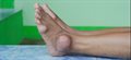 Research shows cases of gout soaring but treatment poor