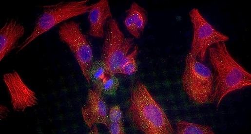 Metastatic medulloblastoma cell visualisation narrow