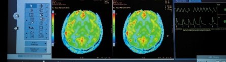 An MRI brain scan