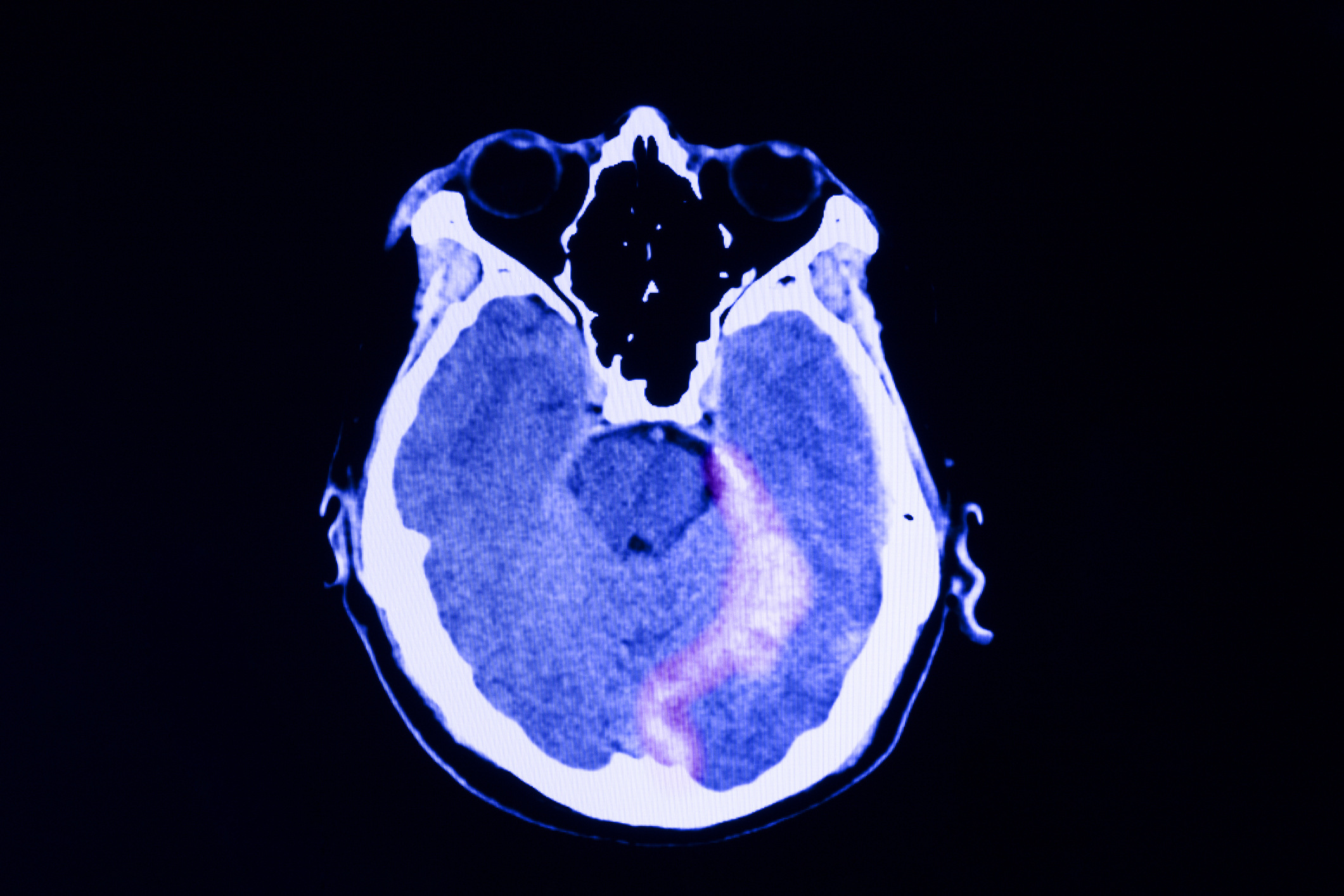 CT scan of the brain of a trumatic brain injury patient showing intracerebral hemorrhage with some degree of brain edema iStock-1073506460