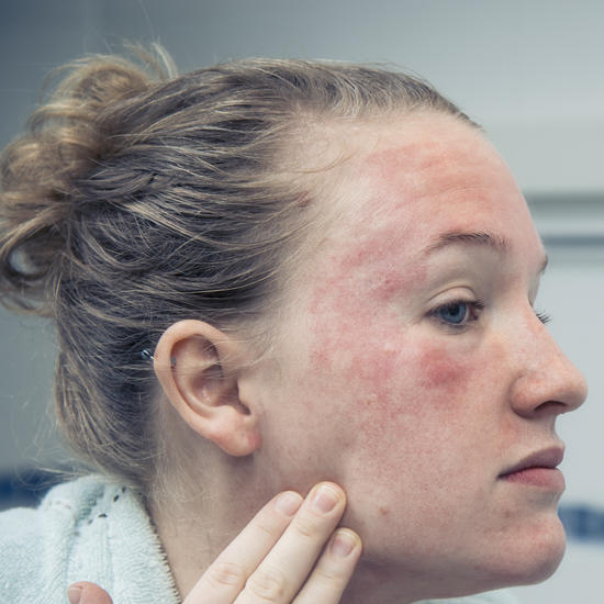 Eczema bathing study