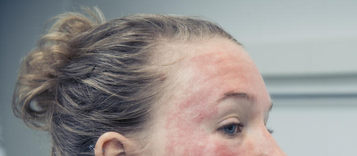 Eczema bathing study