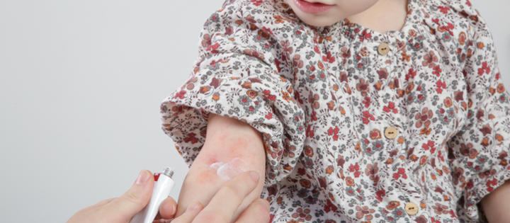 Eczema - children