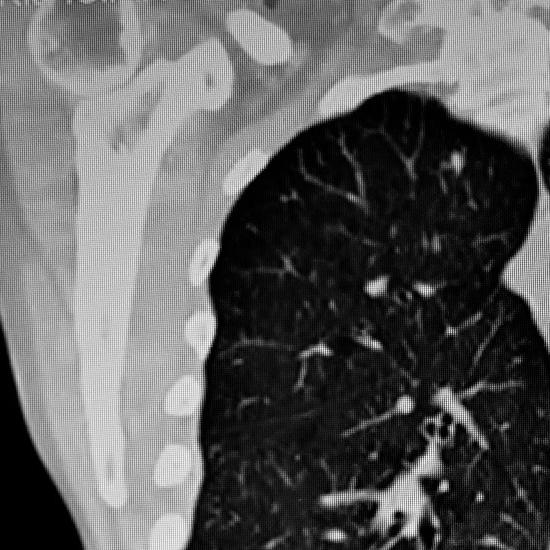 Lung-cancer-web