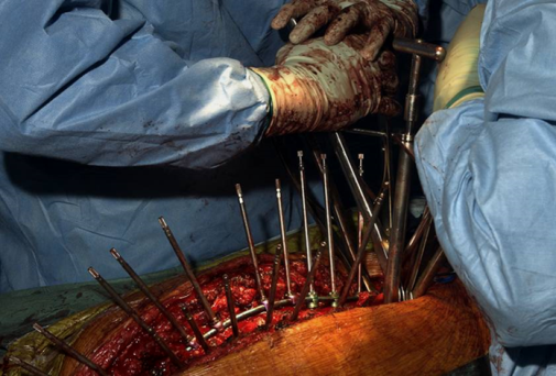 Manual spinal surgery (courtesy to Dr.  Boszczyk, QMC – Nottingham