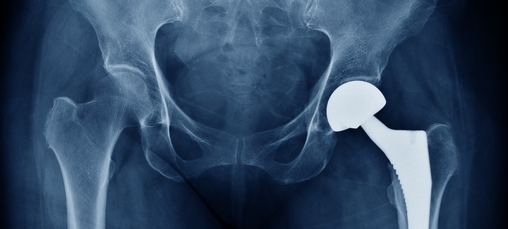 X-Ray of the hips with an implant in the left top leg