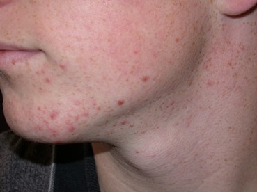 Acne