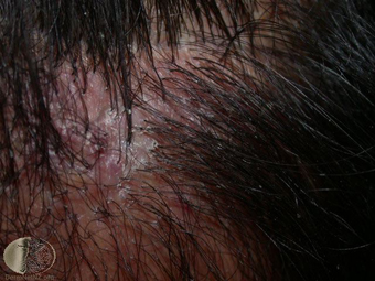 Folliculitis decalvens 2