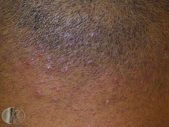 Folliculitis keloidalis 1