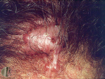 Folliculitis keloidalis 2