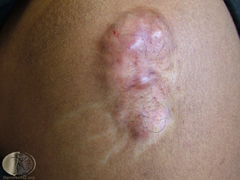 Keloid 1