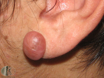 Keloid 2