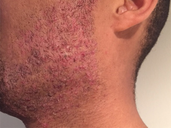 Pseudofolliculitis 1