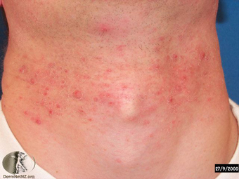 Pseudofolliculitis 2