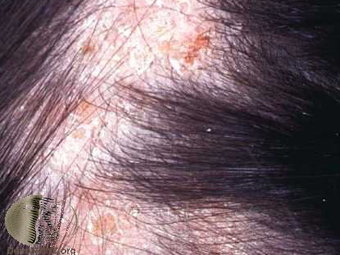 Tinea capitis 1