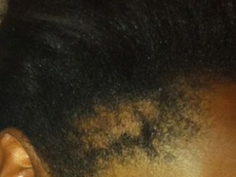Traction alopecia 1