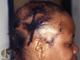Traction alopecia 2