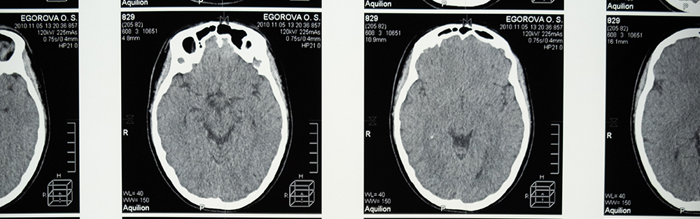 Xray images of the brain