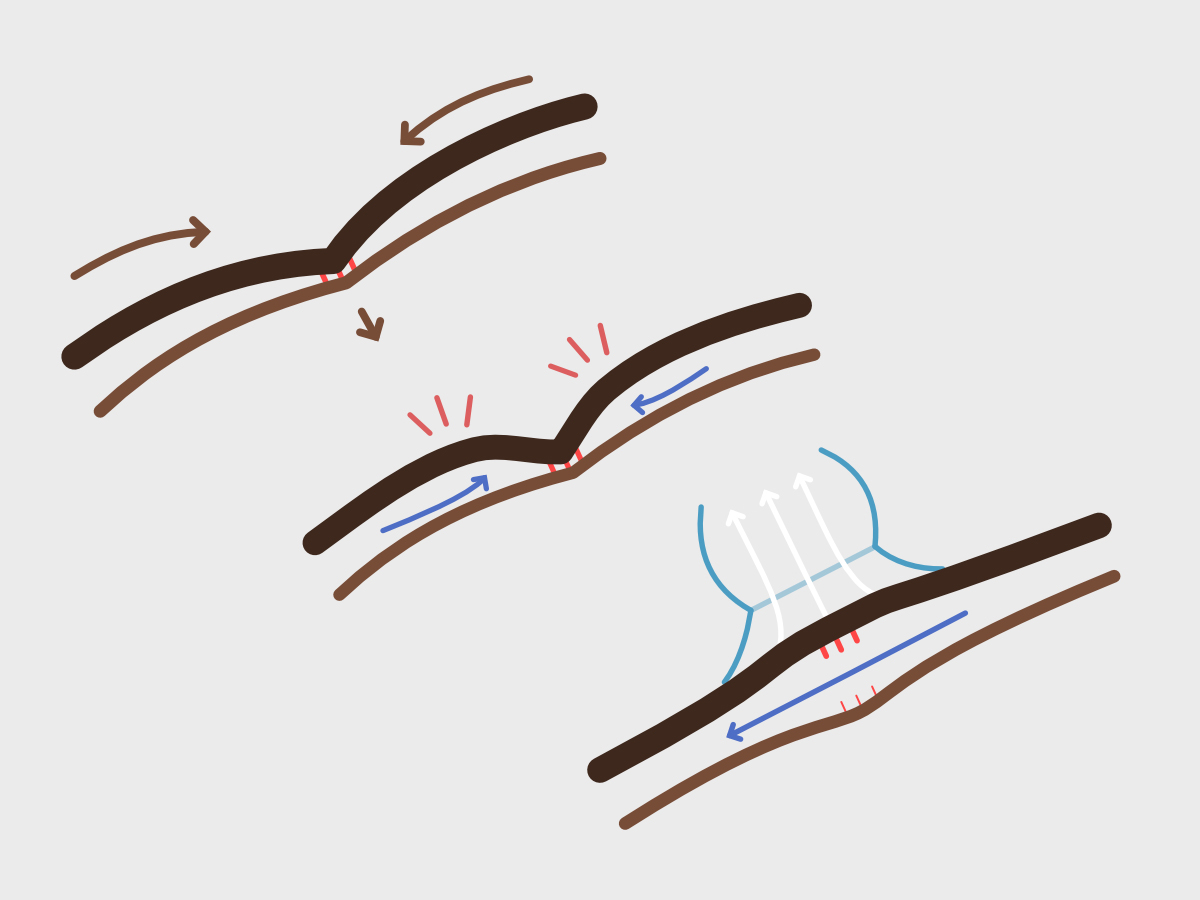 A personal negative pressure wound therapy device for aiding the recovery of C-section scars.