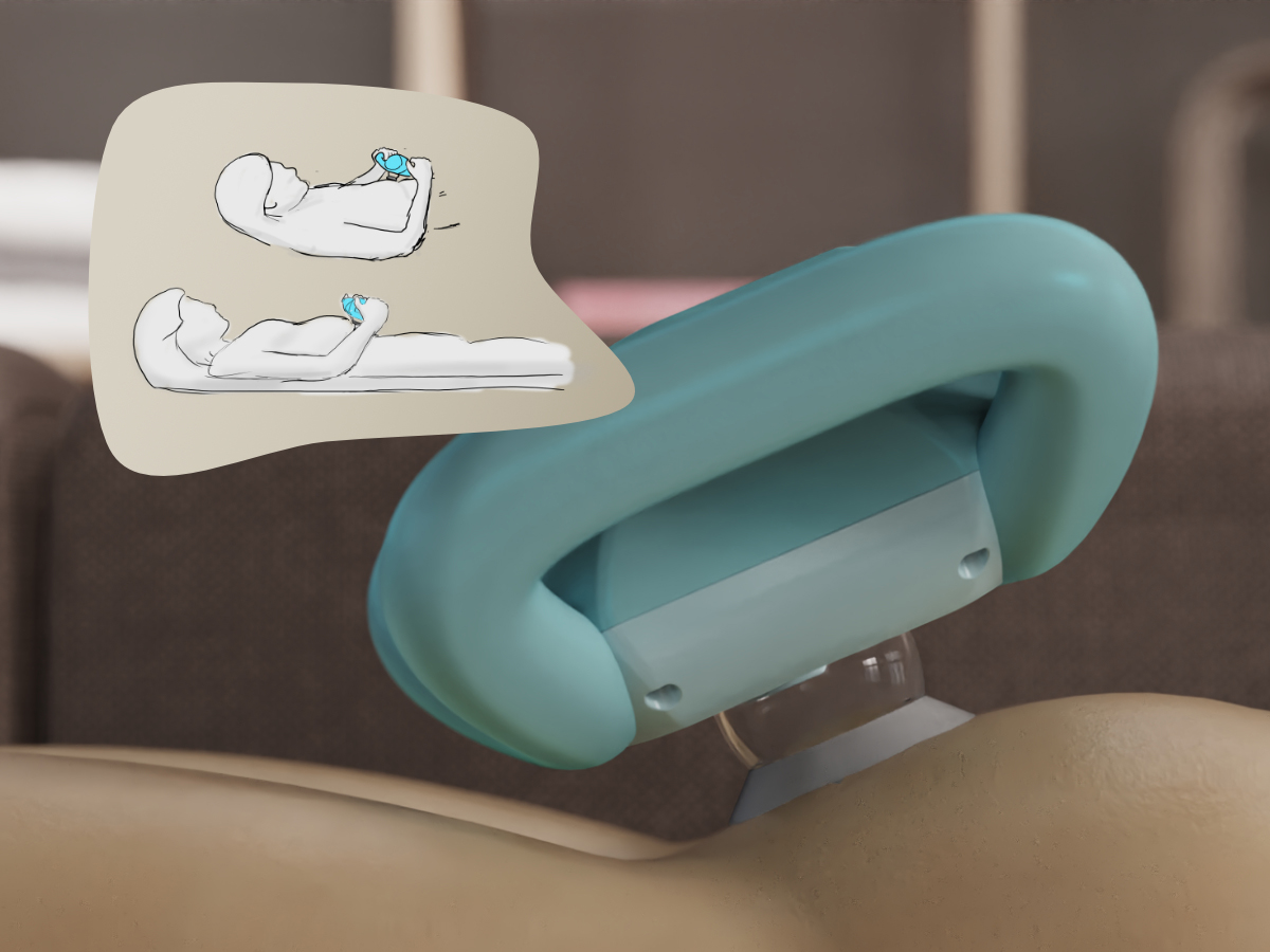 A personal negative pressure wound therapy device for aiding the recovery of C-section scars.