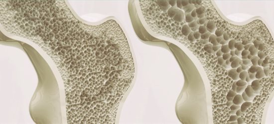 Images showing the stages of osteoporosis in bones