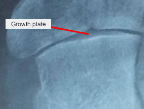 diagram of bone x-ray - indicating the growth plate.