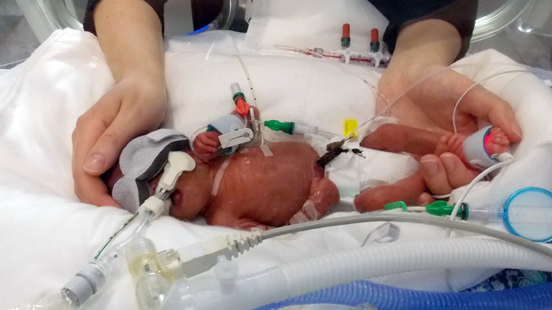 Very Premature Baby in NICU