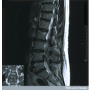 Show Left-sided severe sciatica Image