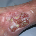 Show Epithelialising Image