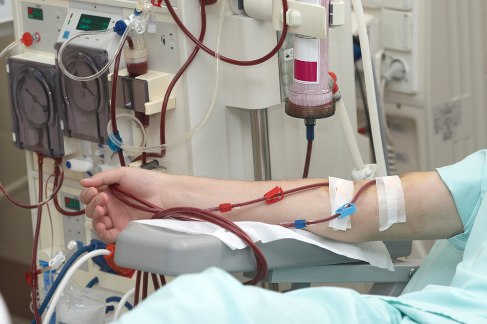 The arm of a patient hooked up to a dialysis machine