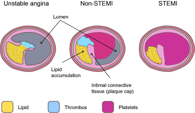 unstable angine, non-STEMI and STEMI