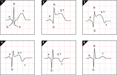 Sequence of changes in evolving AMI