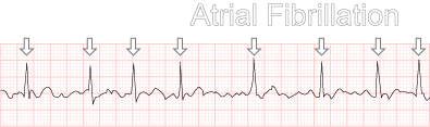 Atrial Fibrillation (AF)