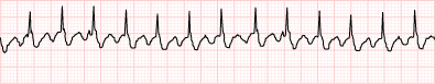 Atrial Flutter with 2:1 block (full strip)