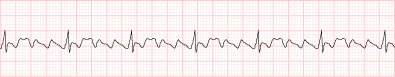 Atrial Flutter with 4:1 block(full strip)