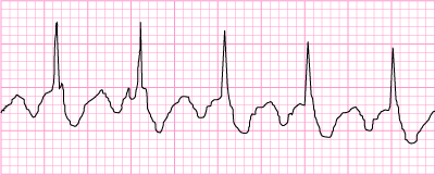 Atrial Flutter with 2:1 block (close up)