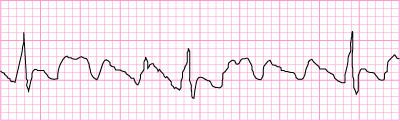 Atrial Flutter with 4:1 block (close up)