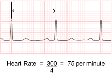 Calculating Heart Rate - Heart rate = 300 / 4 = 75 per minute
