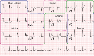 Recreation of an ecg with coresponding regions of the heart highlighted