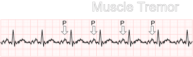 Muscle Tremor