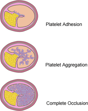 Thrombus Formation - 1. Platelet Adhesion 2. Platelet Aggregation 3. Complete occlusion