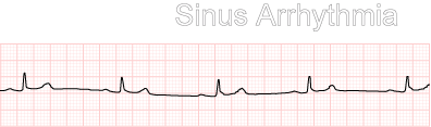 Sinus Arrhythmia Example 1