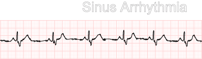 Sinus Arrhythmia Normal Function Of The Heart Cardiology Teaching Package Practice Learning Division Of Nursing The University Of Nottingham
