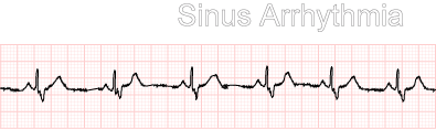 Sinus Arrhythmia Example 2