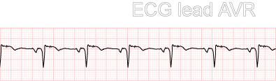 Rhythm strip of sinus rhythm recorded from ECG lead AVR
